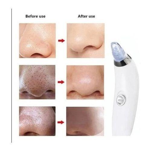 Extracteur de points noirs sous vide avec bouton incurvé